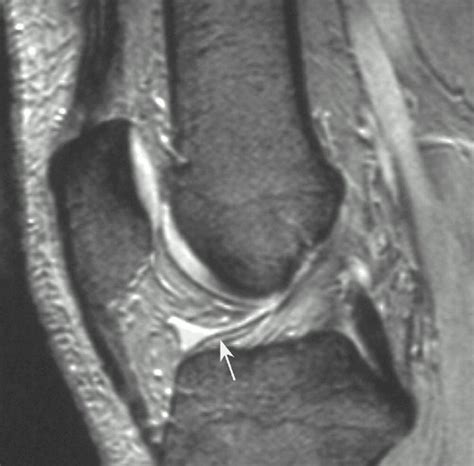 Anatomy and MR Imaging Appearances of Synovial Plicae of the Knee | RadioGraphics