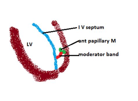 easyhumanatomy: Moderator band / septomarginal trabeculum