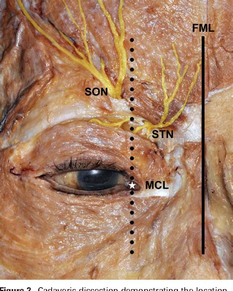 Emerging Points of the Supraorbital and Supratrochlear Nerves in the ...