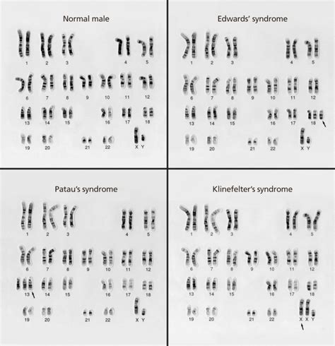 Chromosomal abnormalities and IVF: what you need to know