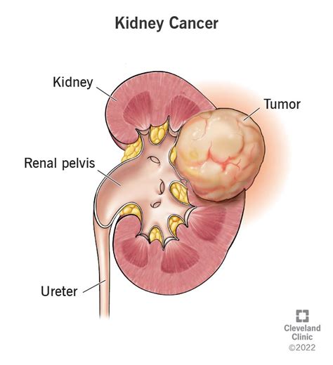 Kidney Cancer: Symptoms, Signs, Causes & Treatment