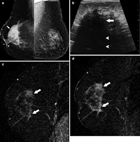 Malignant Breast Tumors | Radiology Key