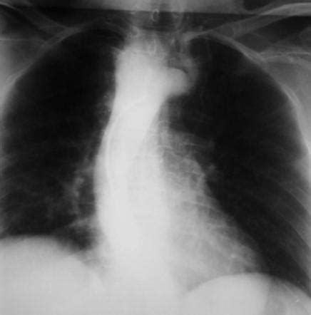 Double aortic arch | Radiology Reference Article | Radiopaedia.org