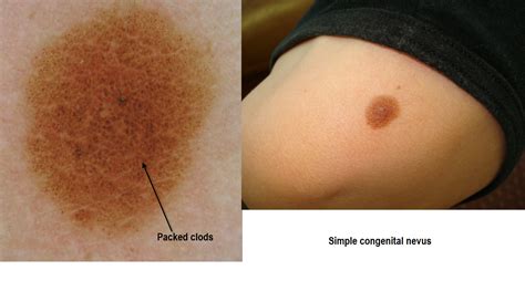 Dermoscopy Made Simple: Congenital nevus