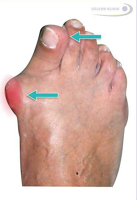 Hallux valgus, the ganglion on the big toe: Conservative treatment or ...