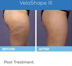 VelaShape - Before and After