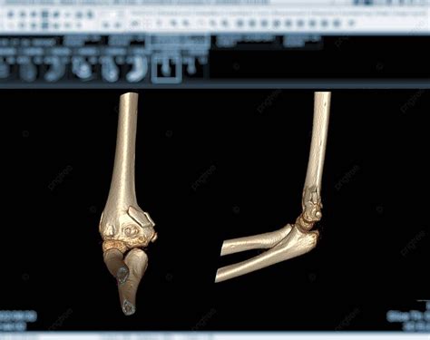 Ct Scan Of Elbow Joint Fracture People Ct Arm Photo Background And Picture For Free Download ...