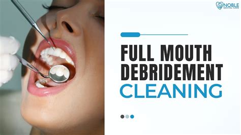 Full Mouth Debridement Cleaning - YouTube