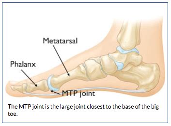 Great Toe Mtp Joint