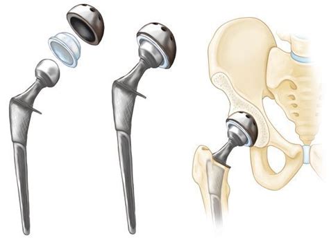 Total Hip Replacement Exercise Guide - OrthoInfo - AAOS | Hip replacement, Hip replacement ...