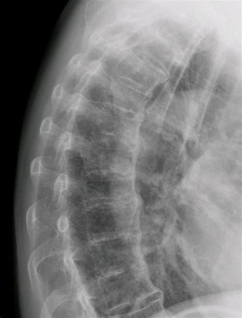 Thoracic Vertebrae X Ray