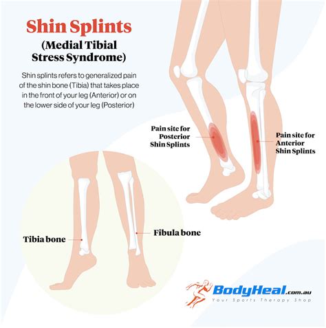 What Is Shin Splints? Causes, Symptoms & Treatment Options – BodyHeal