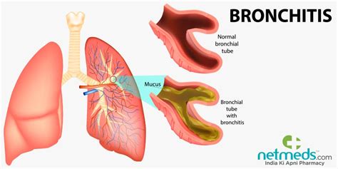 Bronchitis: Causes, Symptoms And Treatment