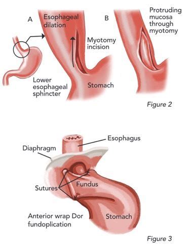 Heller Myotomy: Pre-Operative Education | Mary Washington Healthcare