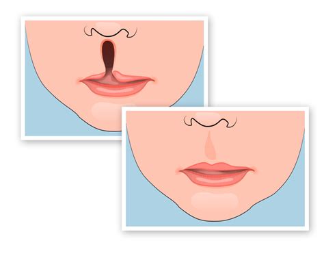 Cleft Lip and Palate Surgery