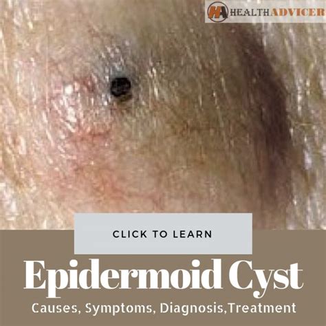 Epidermoid Cyst : Causes, Picture, Symptoms And Treatment