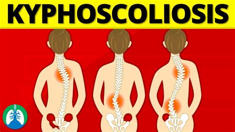 Kyphoscoliosis (Medical Definition) | Quick Explainer Video - YouTube