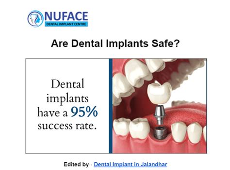 Exploring the Safety of Dental Implants: Risks, Complications, and ...