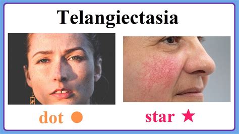 telangiectasia - YouTube