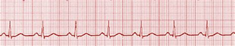 Pulseless Electrical Activity Vs Asystole