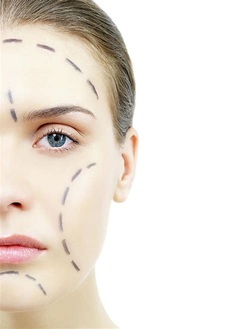 Facelift Surgery Markings Photograph by Kate Jacobs/science Photo Library | Pixels