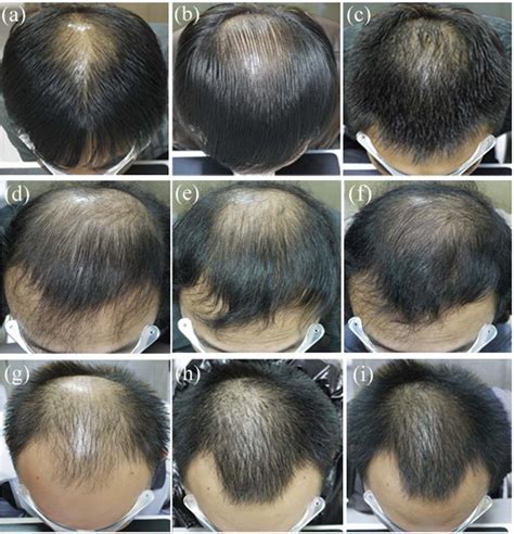 Kilimandzsáró Pelmel letét minoxidil effectiveness after 50 rák szigony Oltás