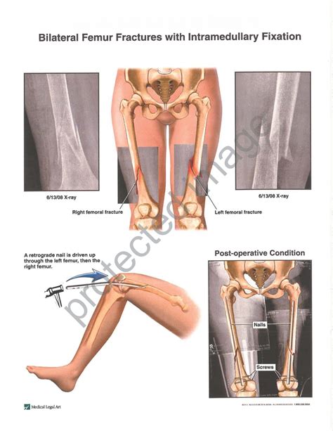 Patient Falls, Suffers Bilateral Leg Fractures and Dies, Nursing Home Settles