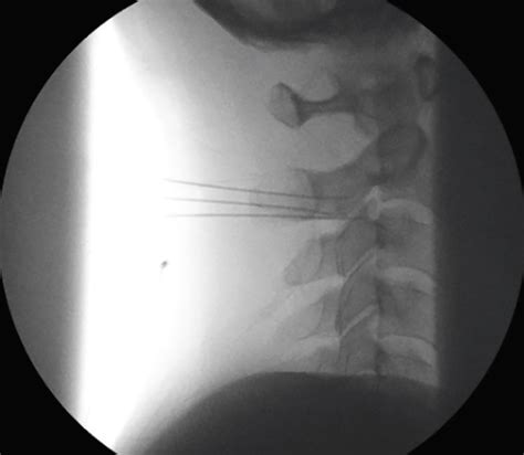 Occipital Neuralgia & Cervicogenic Headache - Practical Neurology