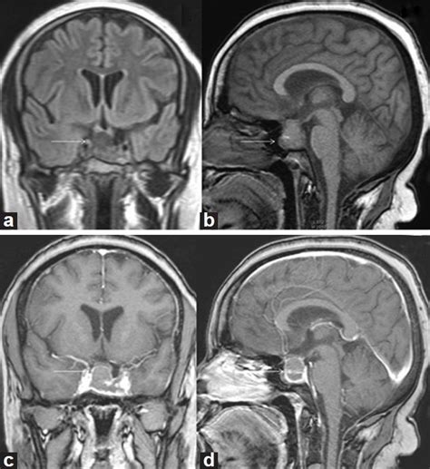 The Role Of Magnetic Resonance Imaging (MRI) In Diagnoses Of Pituitary ...