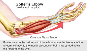 Reduce elbow pain and keep golfing - Arlington Pain and Rehab