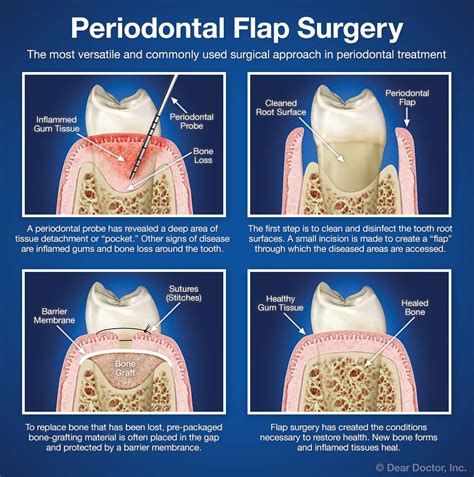 Periodontal Flap Surgery | Coastal Periodontics & Implant Dentistry | Mobile Alabama