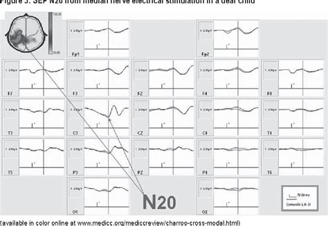 Figure 3 from Cross-modal plasticity in deaf child cochlear implant ...