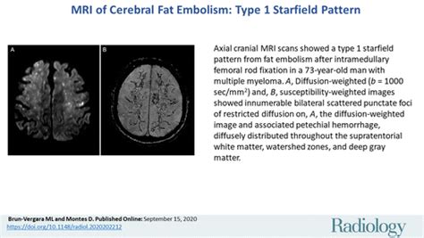 MRI of Cerebral Fat Embolism: Type 1 Starfield Pattern | Radiology