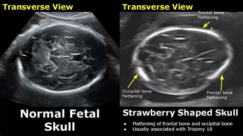 Frontal Bossing Ultrasound