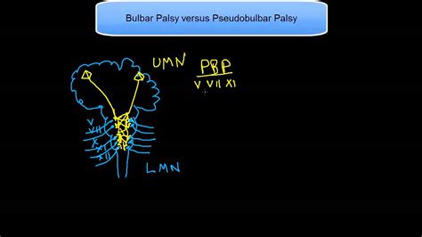 Bulbar Palsy versus Pseudobulbar Palsy - YouTube