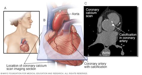 Calcium Score / CT Heart Scan