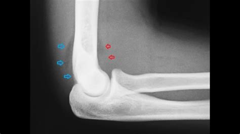 Arthrocentesis of the Elbow Joint - Internet Book Of MSK Ultrasound