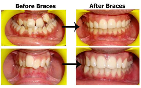 Best Dentist in South Delhi for Braces | Dental Treatment Braces ...