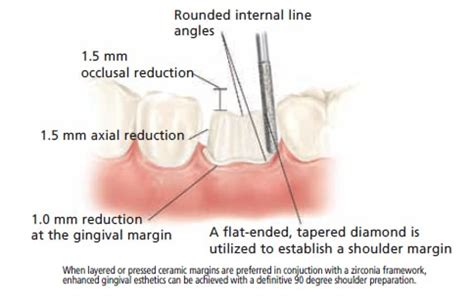 All Ceramic Crown Preparation Guide for IPS e.max® & Z Crown™ - Bayshore Dental Studio