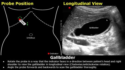 Gallbladder Ultrasound Probe Positioning | Transducer Placement ...