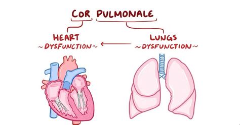 cor pulmonale,what to know?