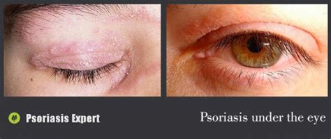 Psoriasis around eyes | Psoriasis expert