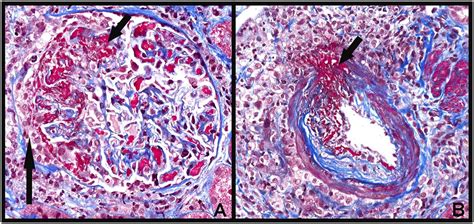 ANCA Glomerulonephritis and Vasculitis : Clinical Journal of the American Society of Nephrology