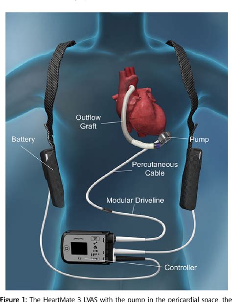 Figure 1 from Multicentre clinical trial experience with the HeartMate 3 left ventricular assist ...