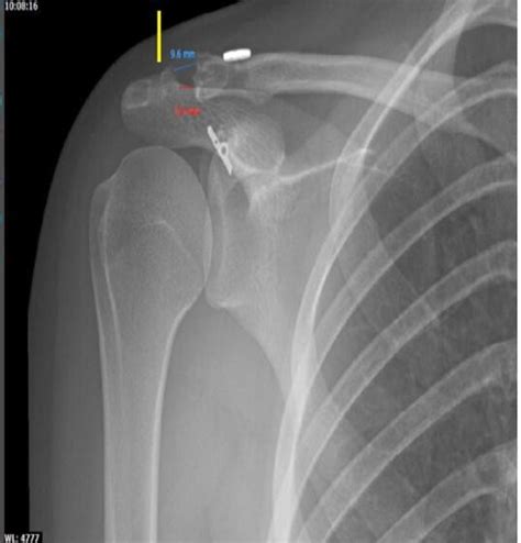 5.5 years post-surgery radiographic control. Correct acromioclavicular... | Download Scientific ...