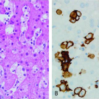 A. Liver sinusoids also demonstrate scattered large atypical-appearing ...