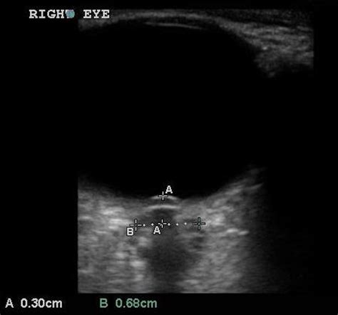 Ocular Ultrasound – Core EM