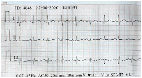 ECG showing prominent S-wave in lead-I and Q-wave with the T-wave ...