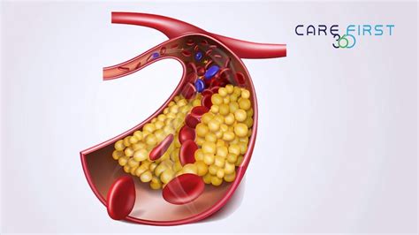 Hyperlipidemia or High Cholesterol: Causes, Diagnosis and Treatment ...