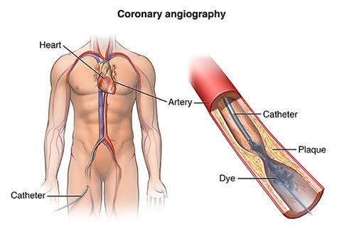 Cardiac Catheterization | Johns Hopkins Medicine